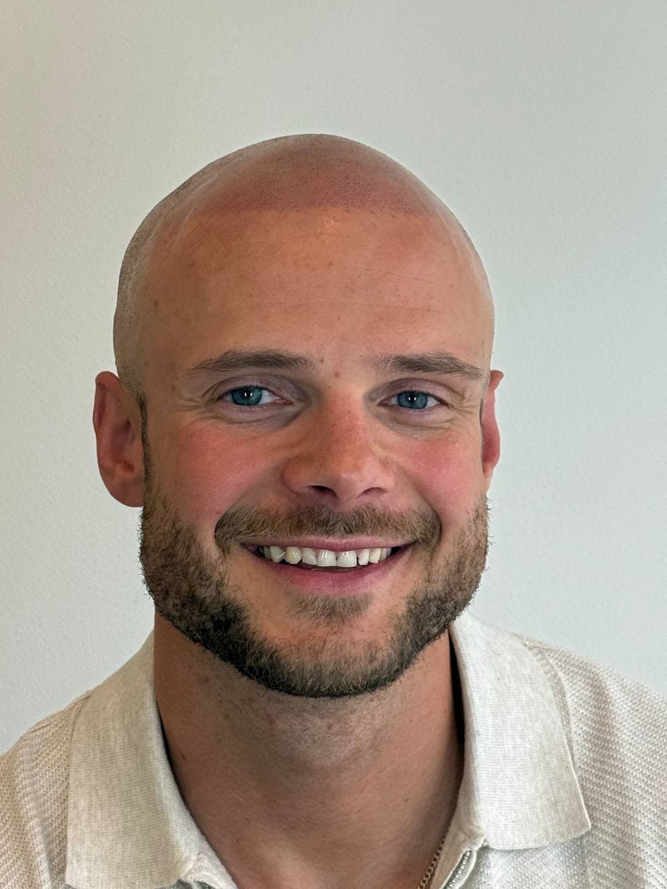 Naturlig innramming etter skalpmikropigmentering