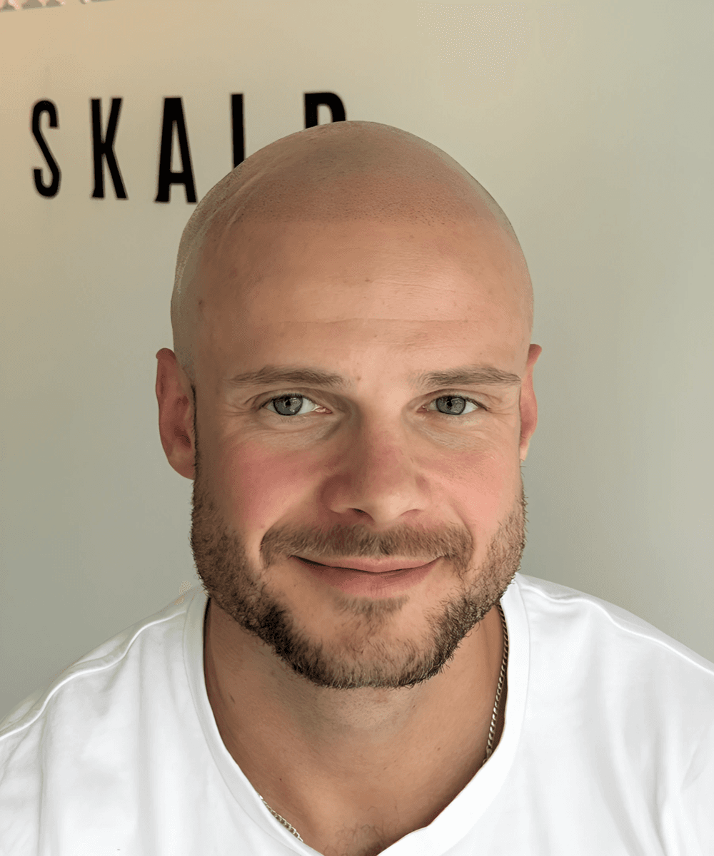 Hodebunn med ferdig skalpmikropigmentering