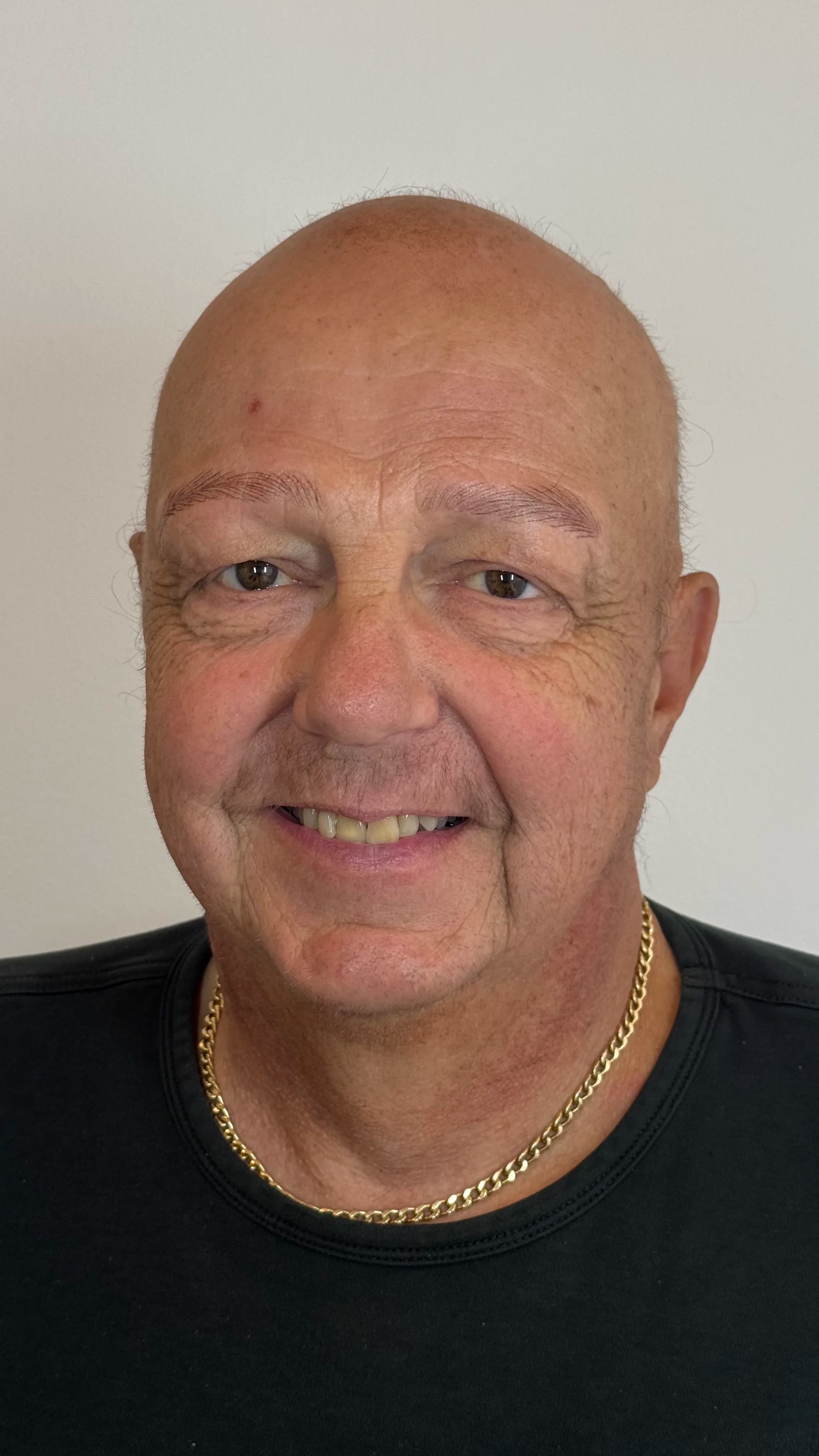 Herrebryn etter PMU-behandling